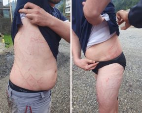 Așa arată corpul unui bărbat lovit parțial de trăsnet în Munții Făgăraș